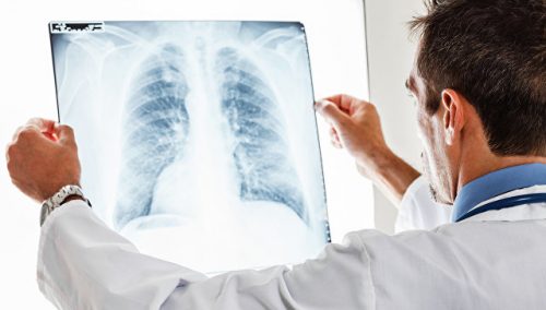 Поради черкаського лікаря: як не захворіти на туберкульоз
