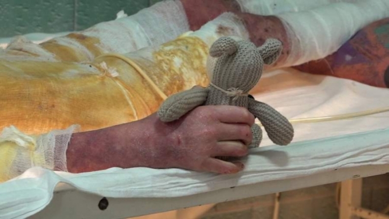 Черкаській дівчинці зробили 5 пересадок шкіри після ураження струмом (відео)