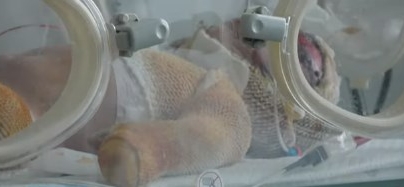 Черкаські лікарі борються за життя малюка, який вижив у пожежі (відео)