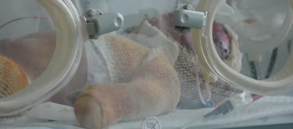 Черкаські лікарі борються за життя малюка, який вижив у пожежі (відео)